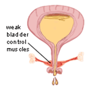cystocele