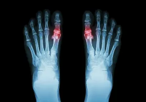 Osteoarthritis : a normal process of aging