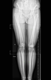 Osteoarthritis : Aging joints on film